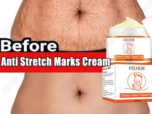 Anti Stretch Marks Cream Removal