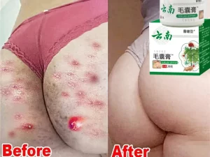 Body Acne Removal Cream Care