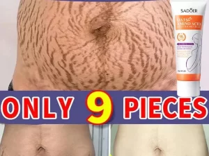 Stretch Mark Removal Cream